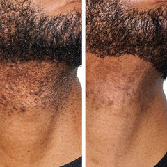 Urban Skin Rx Men's Daily Razor Bump + Dark Spot Treatment 1.7 fl oz - New