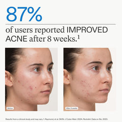 Before and after image showing 87% improvement in acne for users of acne supplements for women after 8 weeks.