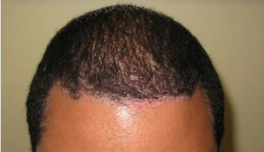 Plaque Psoriasis