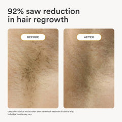 Nood The Flasher 2.0 IPL Permanent Hair Removal - Imperfect Box