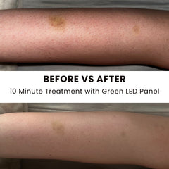 Before and after results of skin treatment using green light therapy panel | H.E.A.L Hair Care