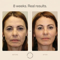 laser light therapy lamp showing before and after results in 8 weeks for skin rejuvenation